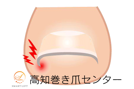 巻き爪矯正の図解